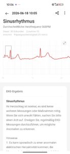 Screenshot Sinurythmus EKG OnePLus Watch 4 Screenshot Sinurythmus EKG OnePLus Watch 4